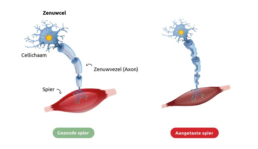 Schematische vergelijking van een spier met ALS en een gezonde spier.