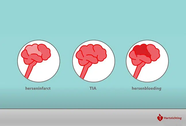 Beroerte uitgelegd hartstichting: herseninfarct, TIA en hersenbloeding