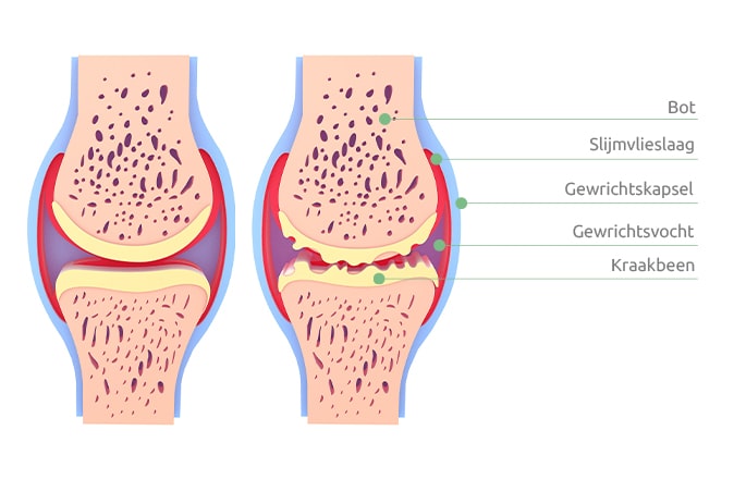 Een schematische afbeelding van een knie met artrose en van een gezonde knie.