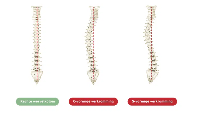 Een rugwervel in normale, rechte, stand, en door scoliose aangetaste wervels in C-vorm en S-vorm laten duidelijk zien hoe scoliose verschillende lichamelijke symptomen kan veroorzaken.