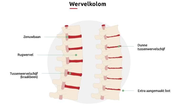 Een schematische weergave van wat is artrose in de rug.