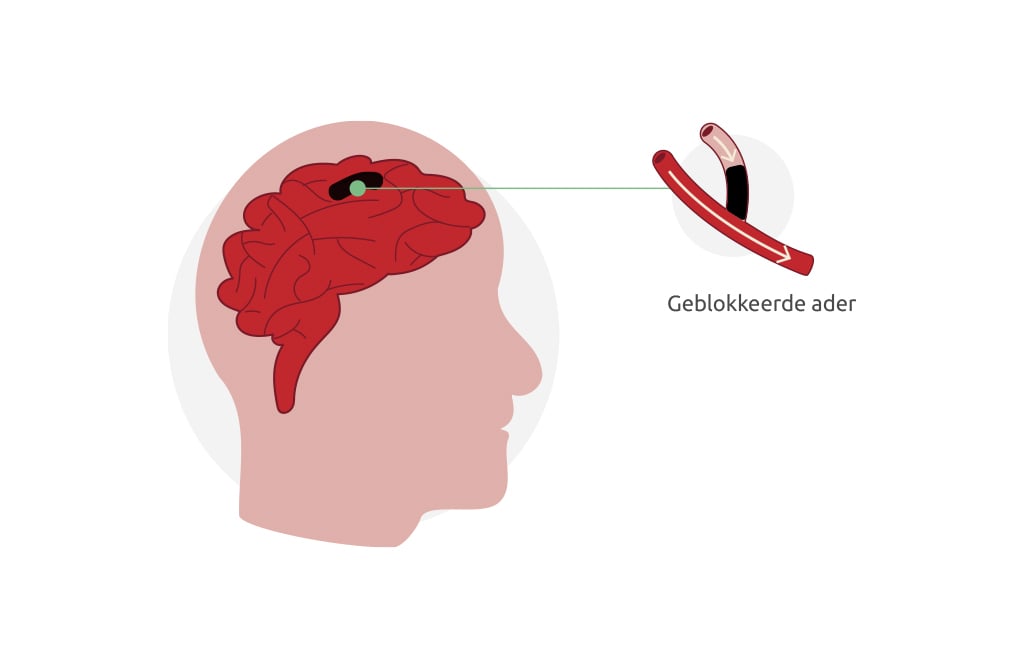 Een herseninfarct ontstaat als een (slag)ader in de hersenen geblokkeerd wordt. Bij een tijdelijke blokkade spreken we van een TIA.